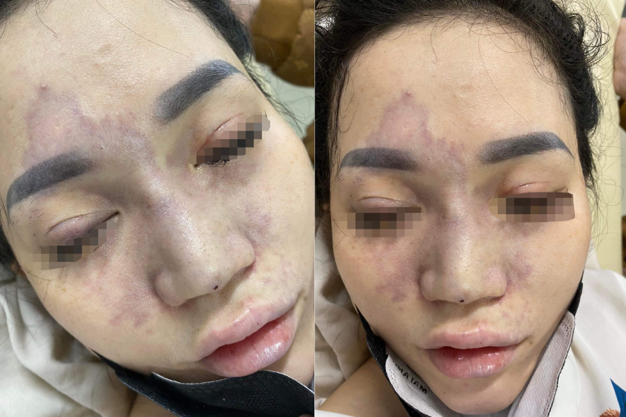 Một cô gái tại thành phố Đà Nẵng hoại tử mắt vì tiêm filler nâng mũi