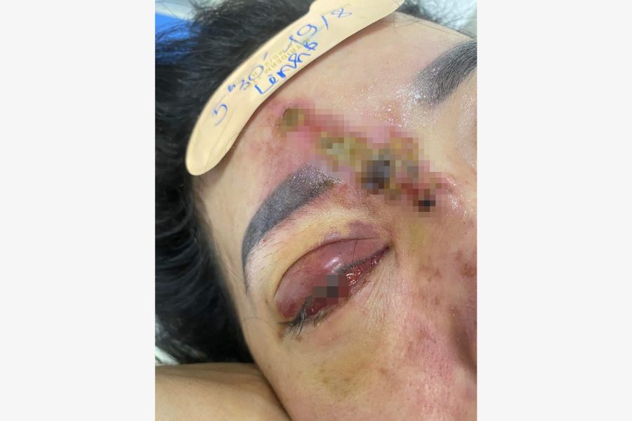 Đà Nẵng: Một cô gái hoại tử mắt vì tiêm filler nâng mũi