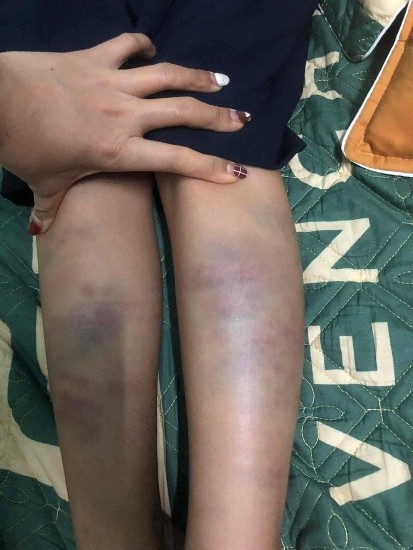 Đà Nẵng: Học sinh lớp 1 bị bạn đánh bầm tím chân, đề nghị kỷ luật giáo viên chủ nhiệm