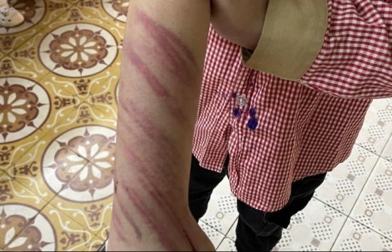 Hải Phòng: Xác minh việc bé trai 8 tuổi bị bạn trai của mẹ bạo hành