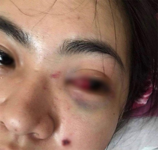 Hà Tĩnh: Nữ sinh bị bạn đánh hội đồng tụ máu mắt vì mâu thuẫn