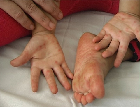 Ninh Thuận: Số ca mắc bệnh tay chân miệng tăng 10,6 lần so với cùng kỳ