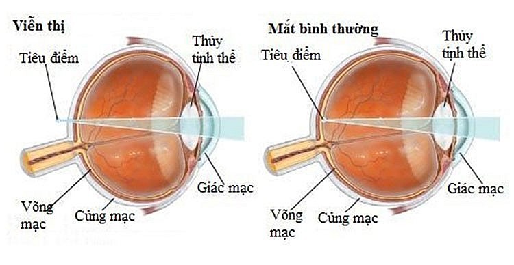 Nguyên nhân gây viễn thị và cách điều trị