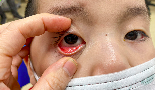 Ninh Thuận: Đau mắt đỏ có nguy cơ bùng phát mạnh