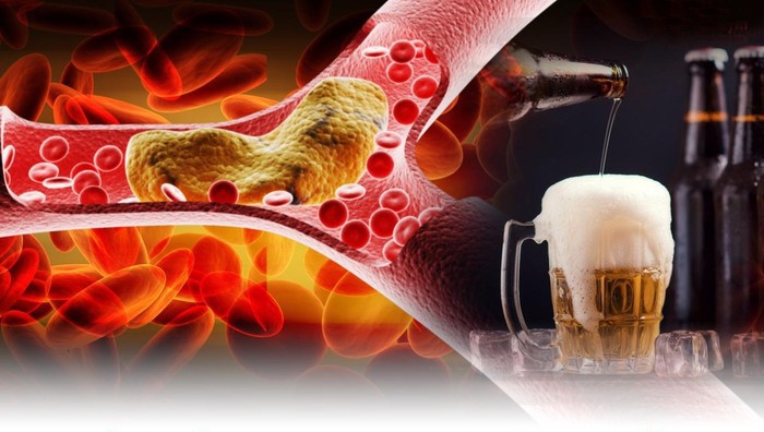 Uống nhiều rượu bia tăng nguy cơ đột quỵ trong mùa lạnh đối với người cao huyết áp