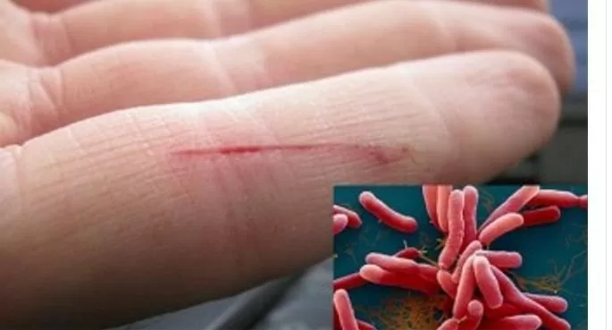 Cảnh báo: Thêm nhiều người nguy kịch vì nhiễm “vi khuẩn ăn thịt người”
