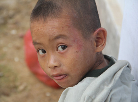 Một em bé bị kiến ba khoang đốt gây viêm da trên mặt. Ảnh: Đăng Nguyên.