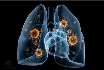 Nhận biết triệu chứng và điều trị bệnh lao phổi
