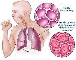 Viêm phổi - nguyên nhân tử vong hàng đầu trong các bệnh về đường hô hấp