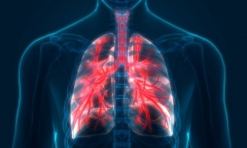 Triệu chứng và cách chữa bệnh phổi tắc nghẽn mãn tính