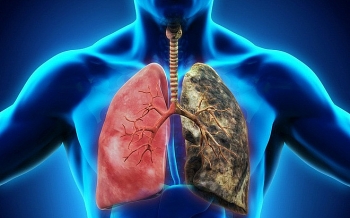 Ung thư phổi và cách phòng tránh