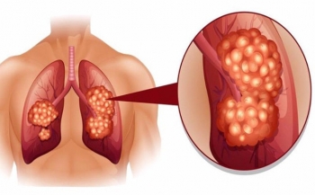 Nhận biết dấu hiệu sớm của ung thư phổi