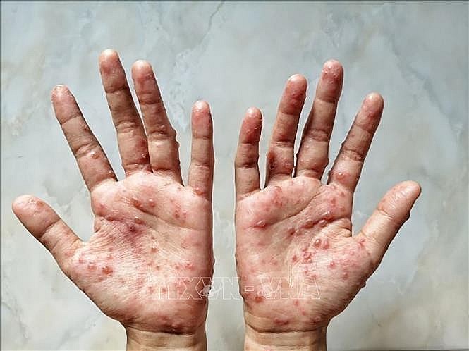 Các ban đỏ nổi trên tay một bệnh nhân mắc đậu mùa khỉ