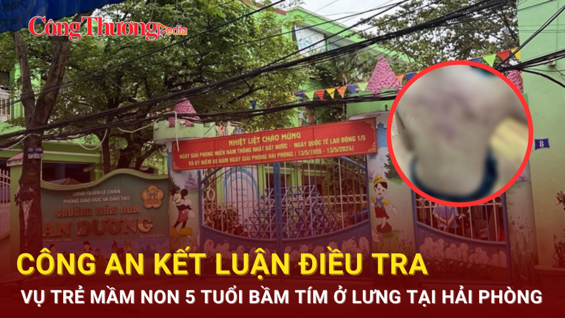 Công an kết luận điều tra vụ trẻ mầm non 5 tuổi bầm tím ở lưng tại Hải Phòng